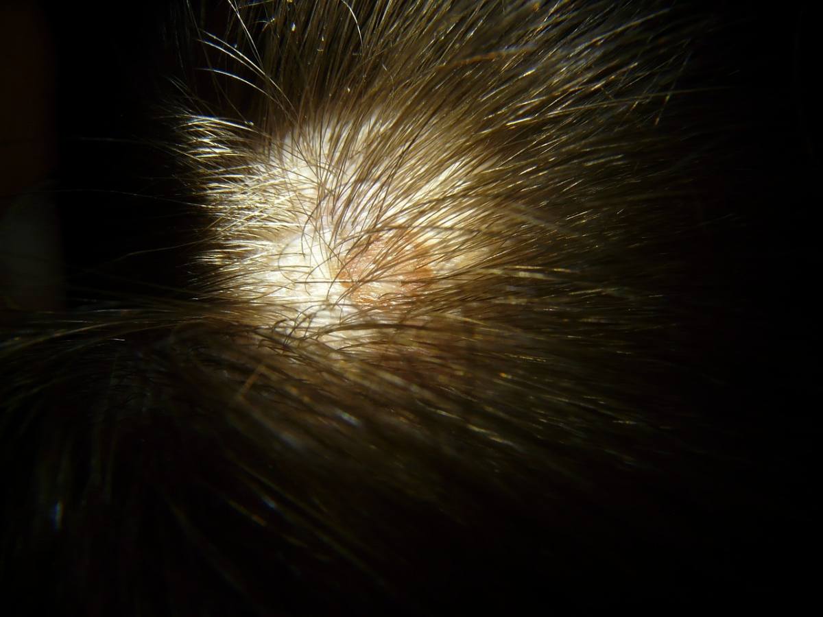 7 raisons pour lesquelles votre cuir chevelu est sensible à un seul endroit