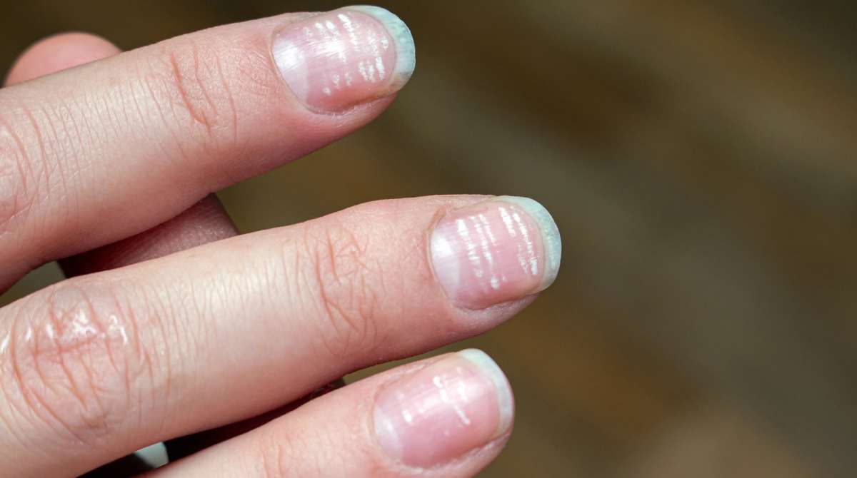 Pourquoi ai-je des taches blanches sur mes ongles ?